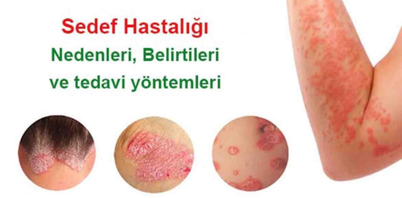 Psoriasis (Sedef Hastalığı) Nedir